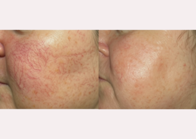 Laser Treatment