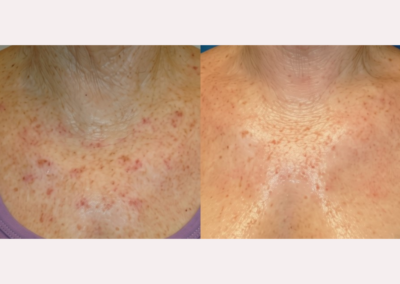 Laser Treatment