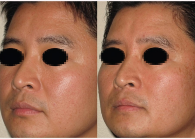 Laser Treatment